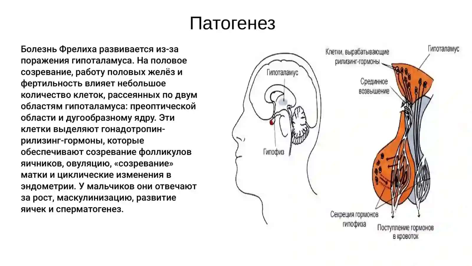 Адипозогенитальная дистрофия (Болезнь Фрелиха) 4