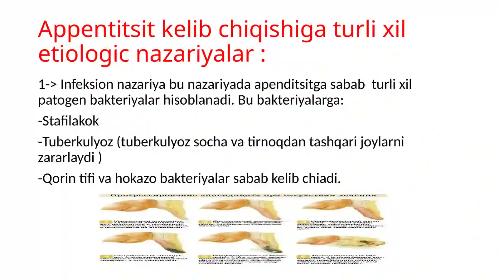 O’tkir appenditsit 4