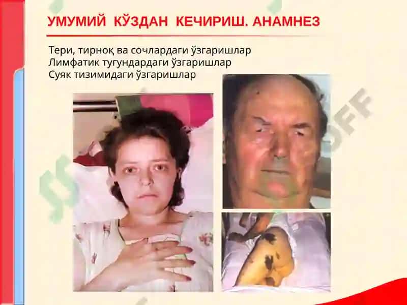 КОН ТИЗИМИ КАСАЛЛИКЛАРИ БИЛАН КАСАЛЛАНГАН БЕМОРЛАРНИ ТЕКШИРИШ. АСОСИЙ КЛИНИК СИМПТОМЛАР 5