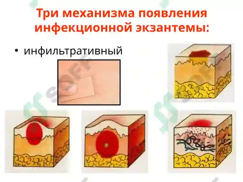 Инфекционные экзантемы 6