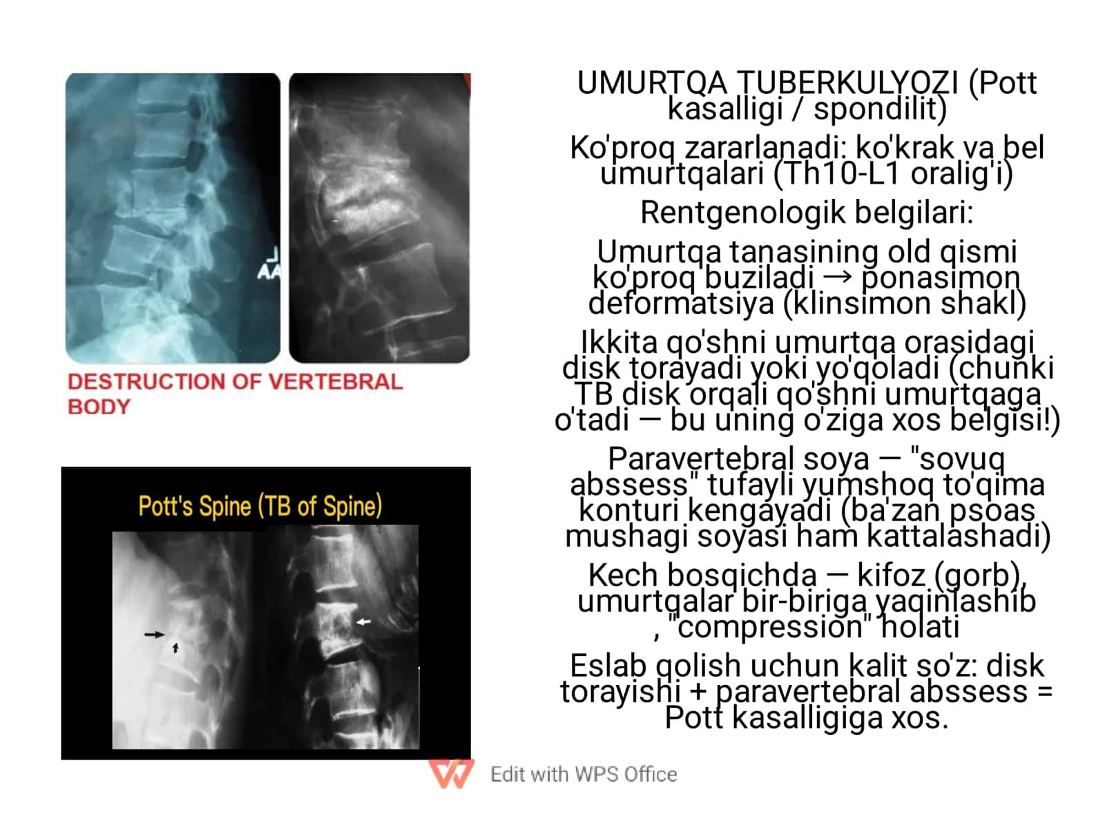 UMURTQA TUBERKULYOZI (Pott kasalligi / spondilit)