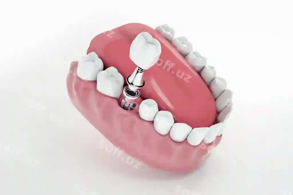 Ko'rinish soxyo tish implanti qat'iy tirsak 3d illustratsiyasi | View from false tooth implant fixed jawbone 3d 3d illustration