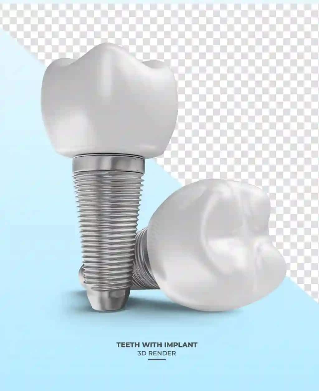 Shaffof fon bilan implantlangan tishning 3D render tasviri | Tooth with implants 3d render with transparent background