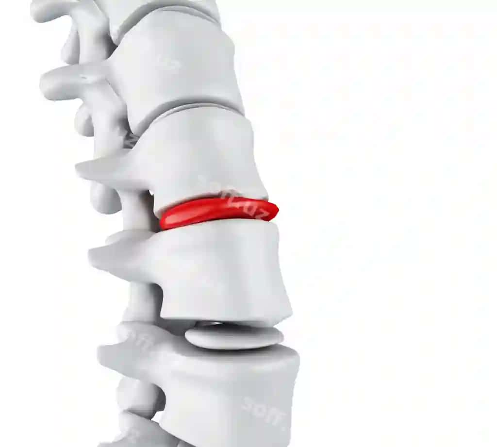 3D churrali disk tushunchasi | 3d herniated disk concept