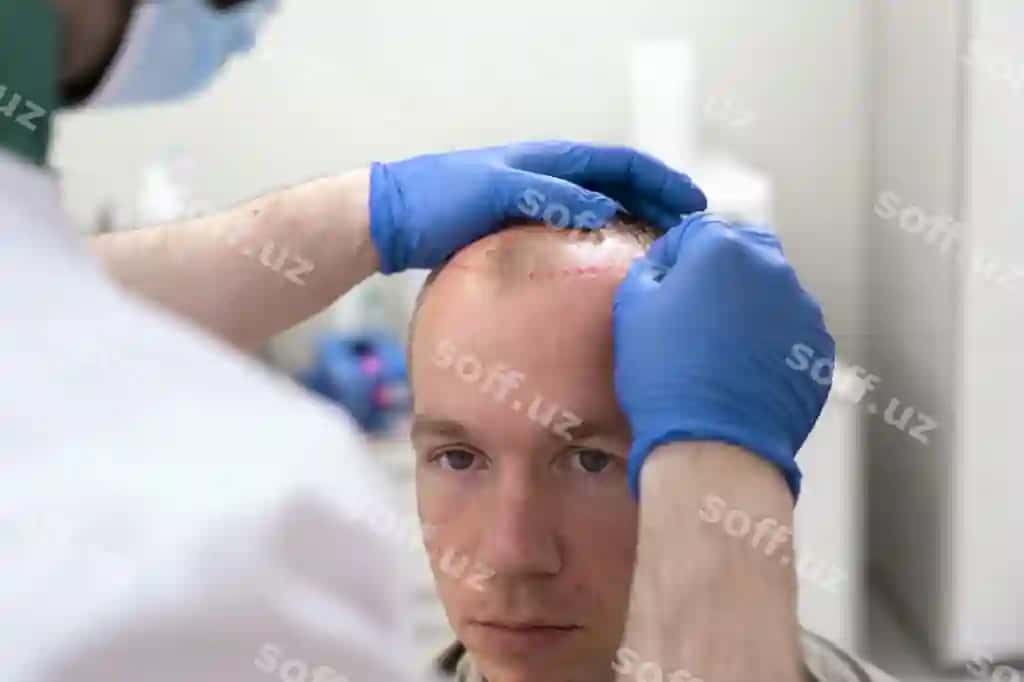 Katta erkak sochlarning ketish muammolari bor | Adult male having balding problems