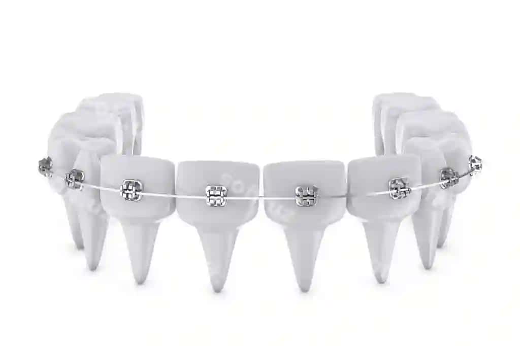 Tish qisqartmalari | Dental brackets