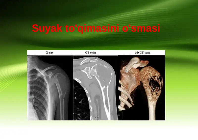 Suyak to'qimasini o'smasi