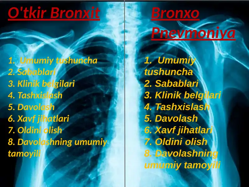 O'tkir Bronxit. Bronxopnevmoniya