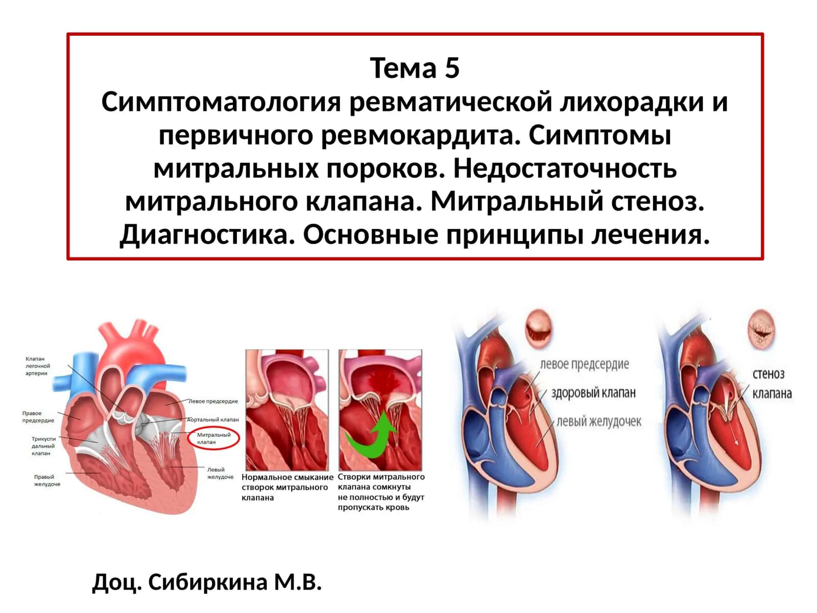 ОСТРАЯ РЕВМАТИЧЕСКАЯ ЛИХОРАДКА, ОПРЕДЕЛЕНИЕ