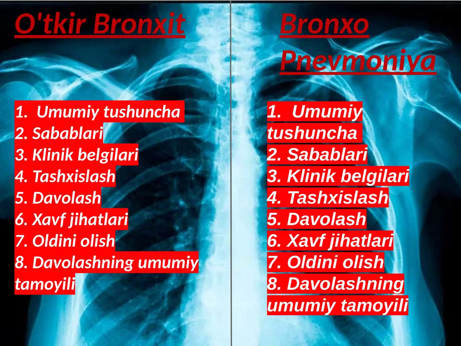 O'tkir bronxit va bronxo pnevmoniya