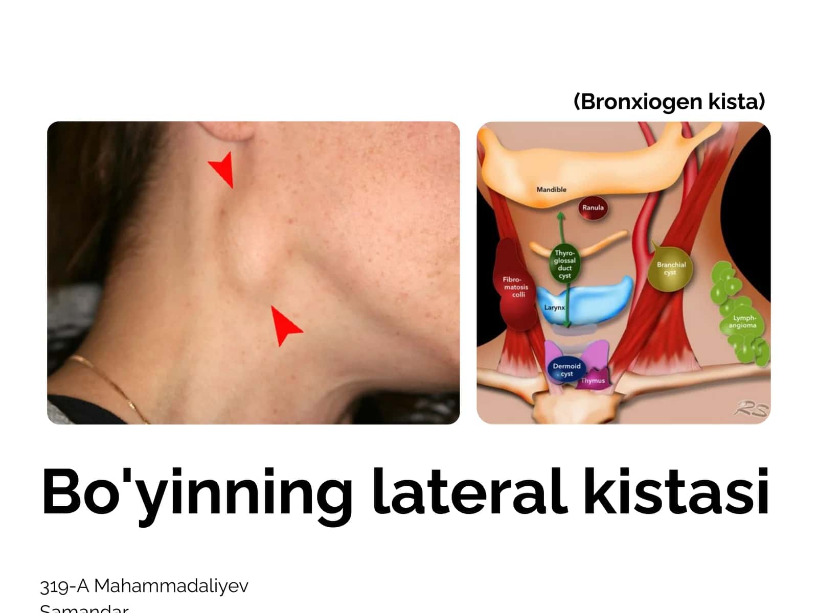 Bo'yinning lateral kistasi