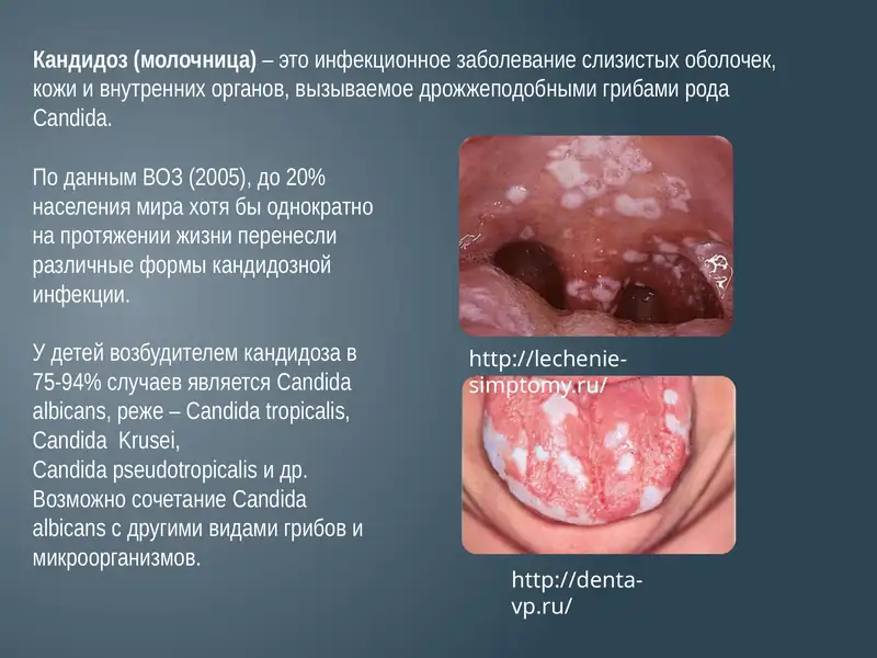 Кандидоз(молочница)