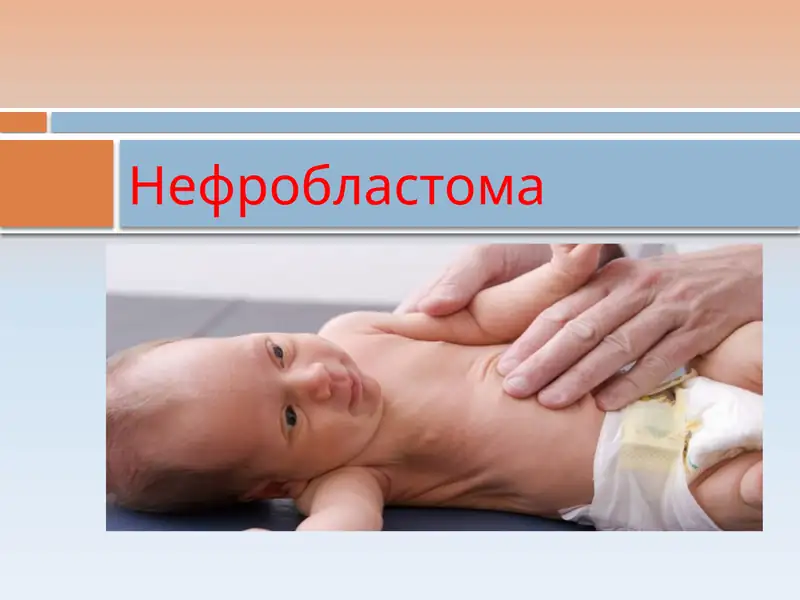 Нефробластома