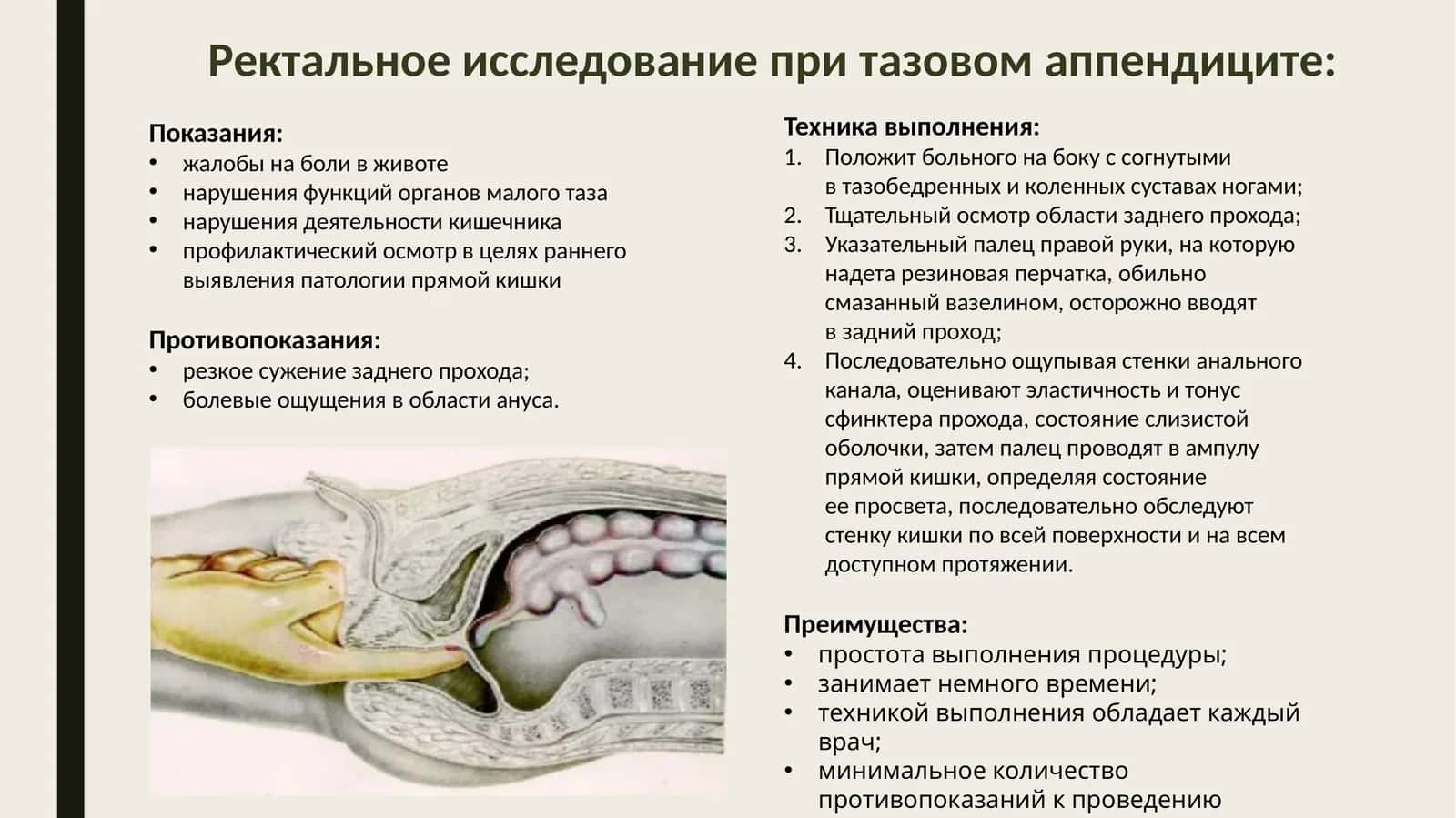 Ректальное исследование при тазовом аппендиците