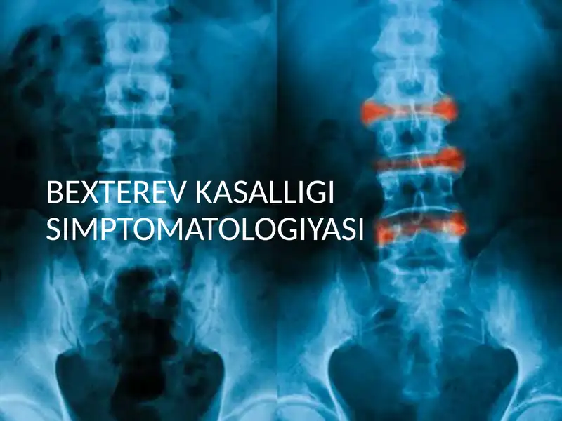 Bexterev kasalligi