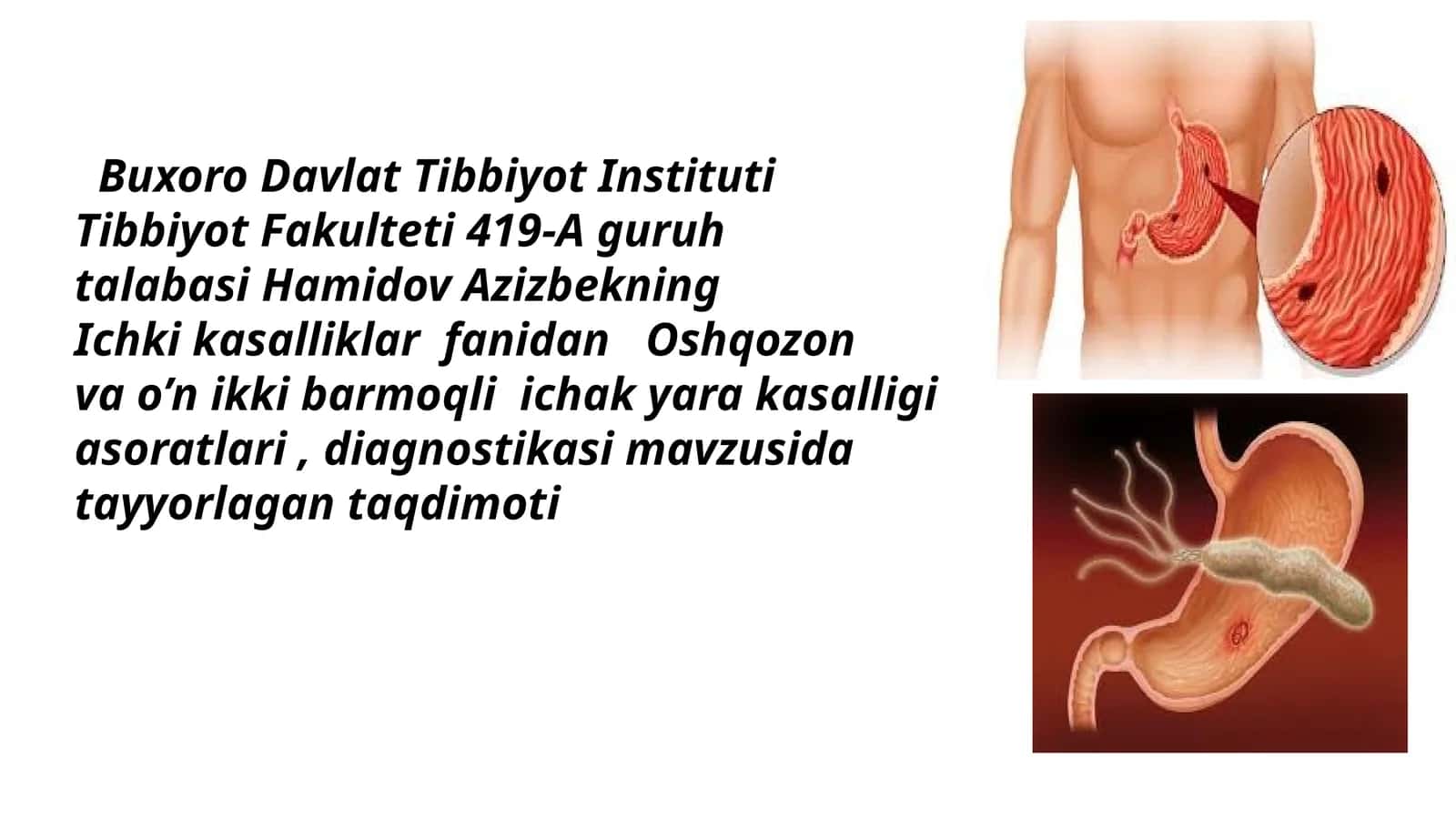 Oshqozon va o‘n ikki barmoqli ichak yara kasalligi