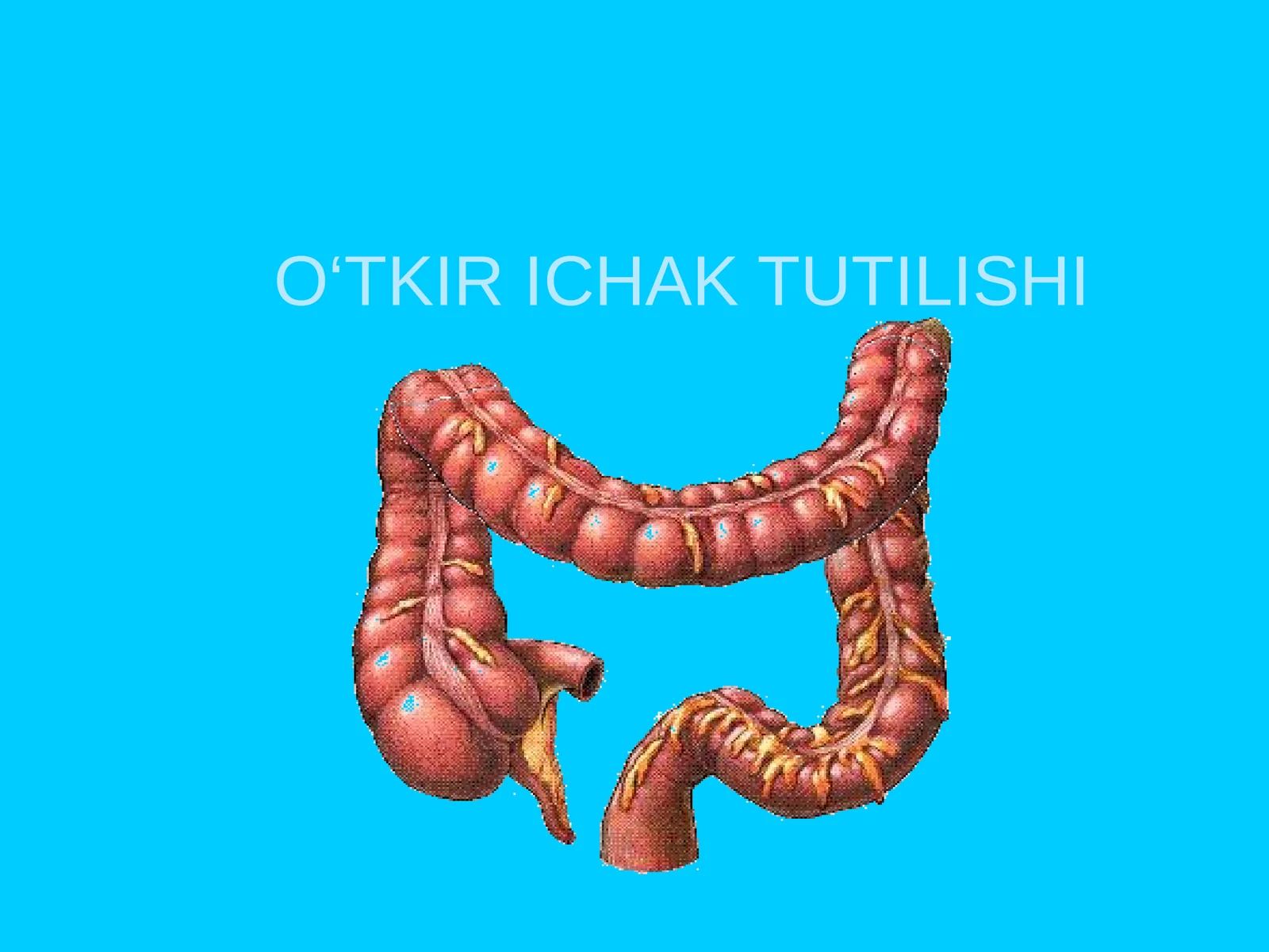 O‘TKIR ICHAK TUTILISHI