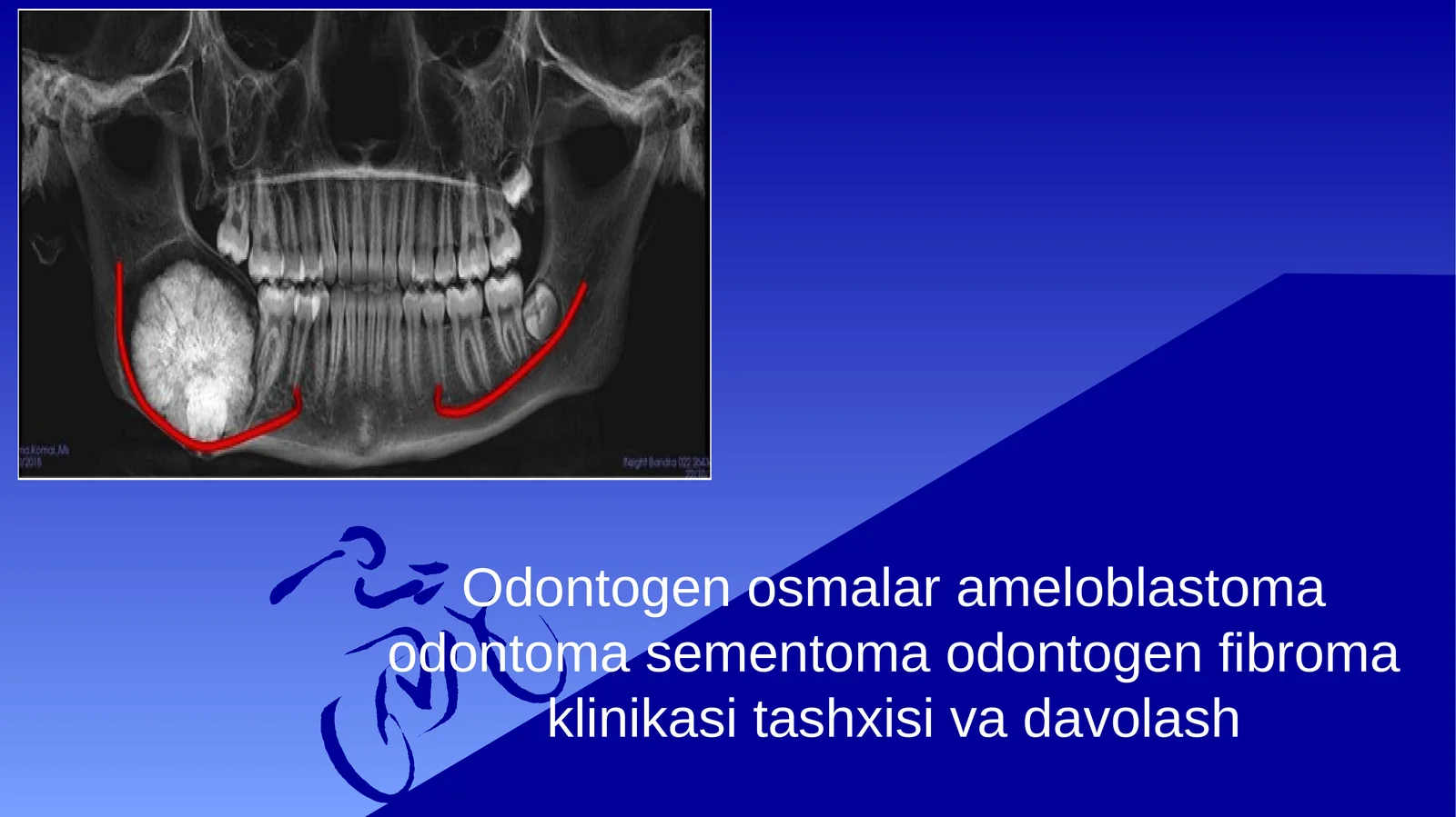 Odontogen osmalar ameloblastoma odontoma sementoma odontogen fibroma klinikasi tashxisi va davolash
