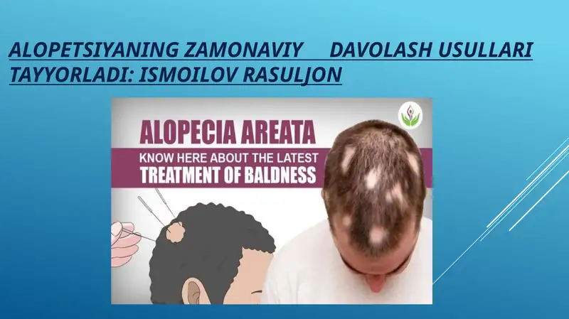 ALOPETSIYANING ZAMONAVIY DAVOLASH USULLARI
