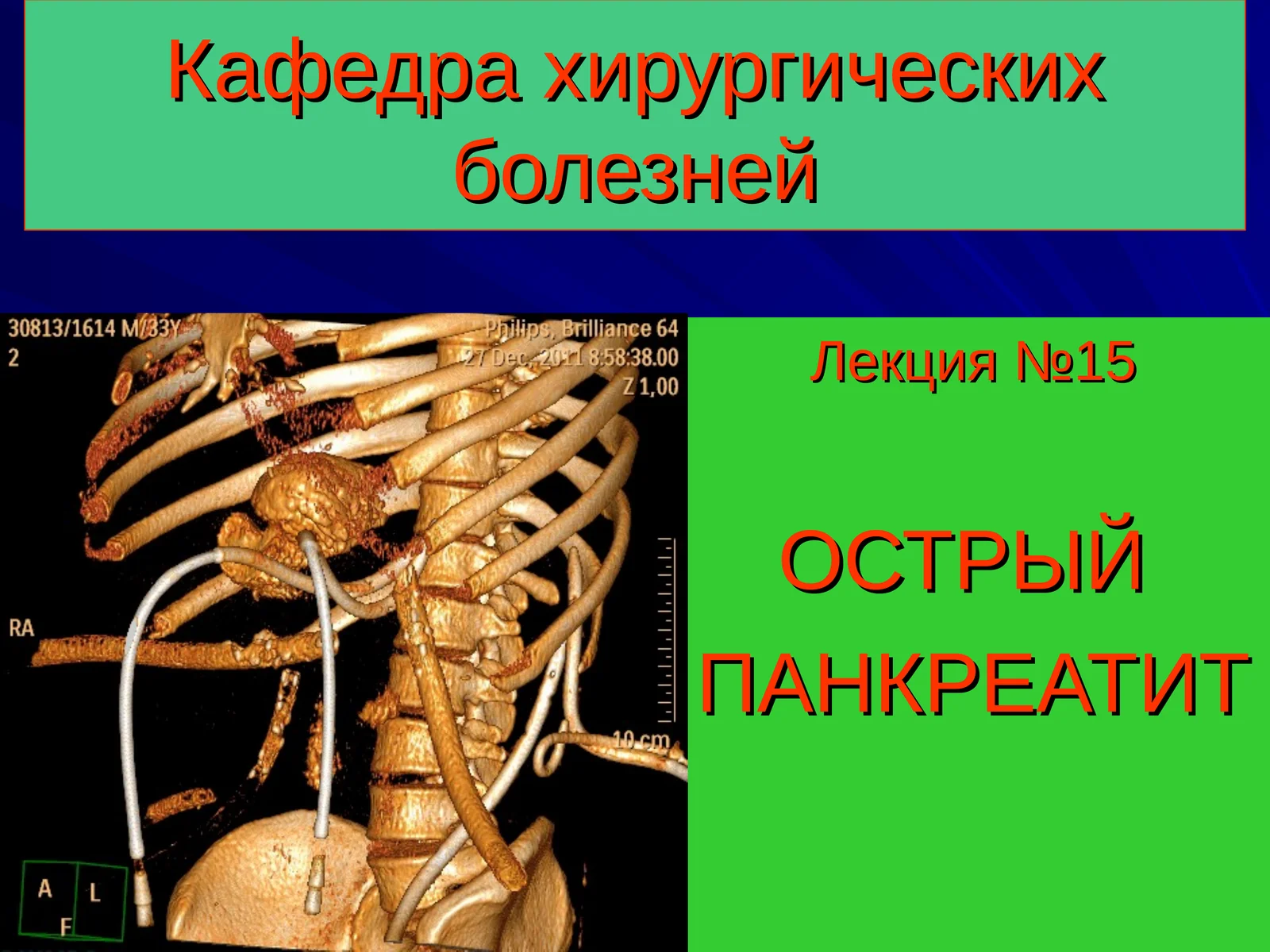 ОСТРЫЙ ПАНКРЕАТИТ