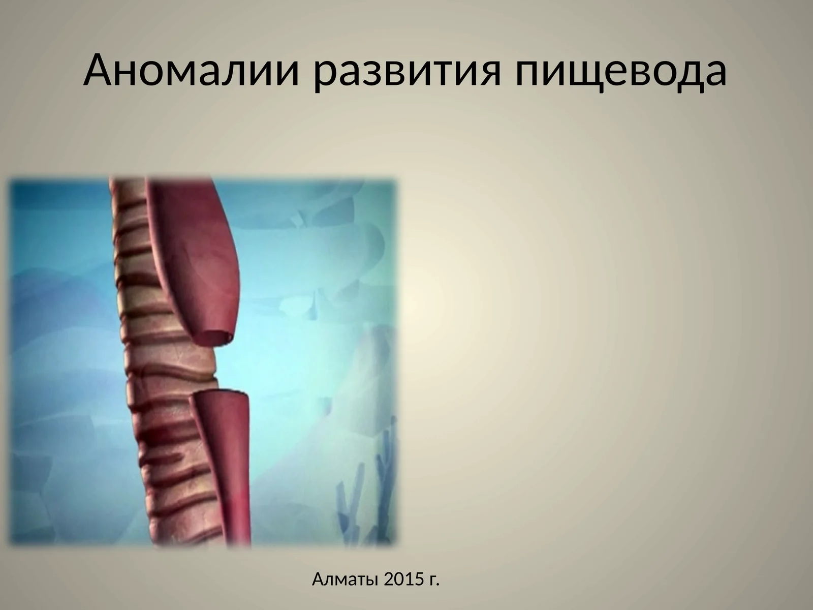 Аномалии развития пищевода