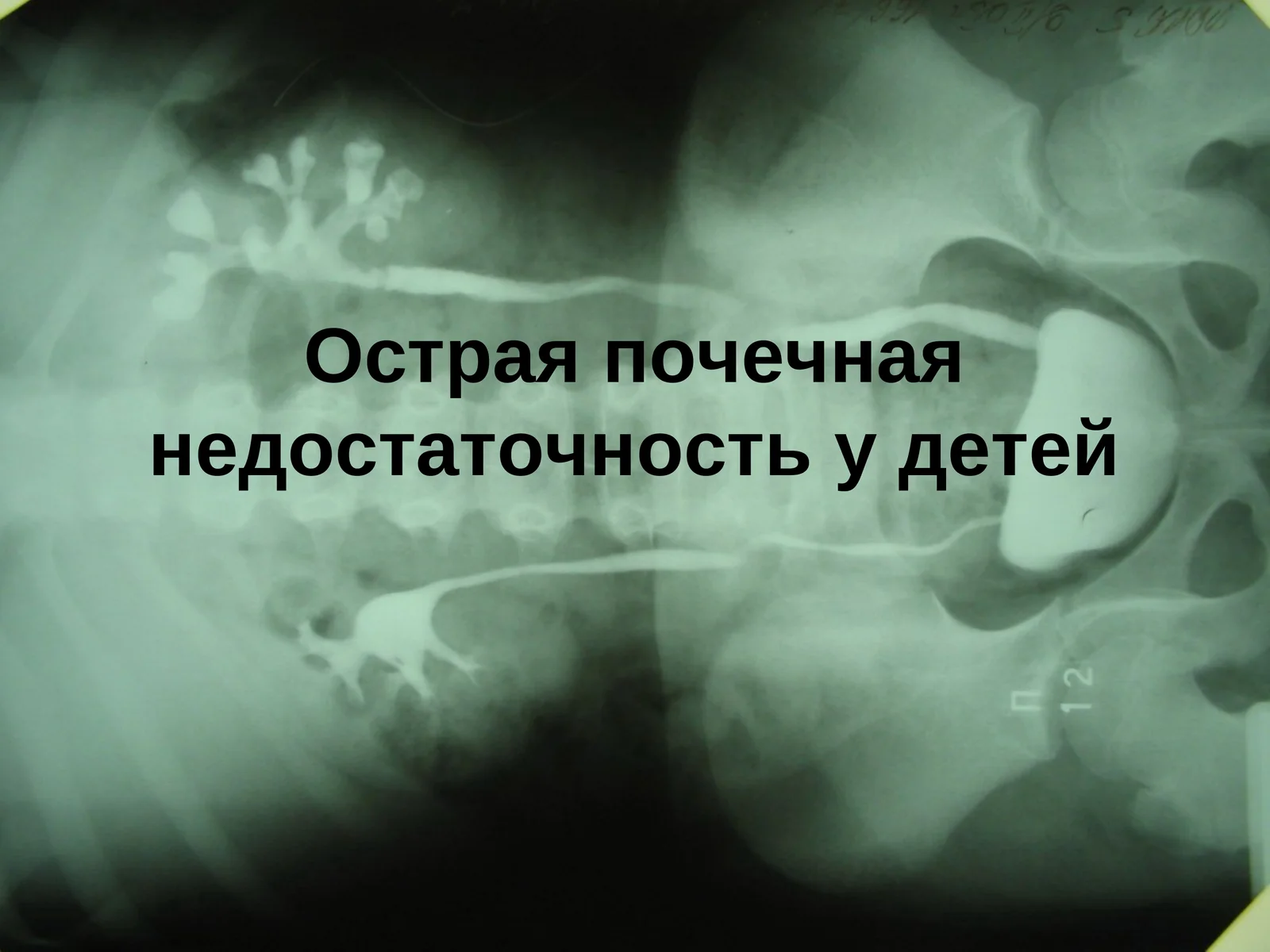 Острая почечная недостаточность у детей