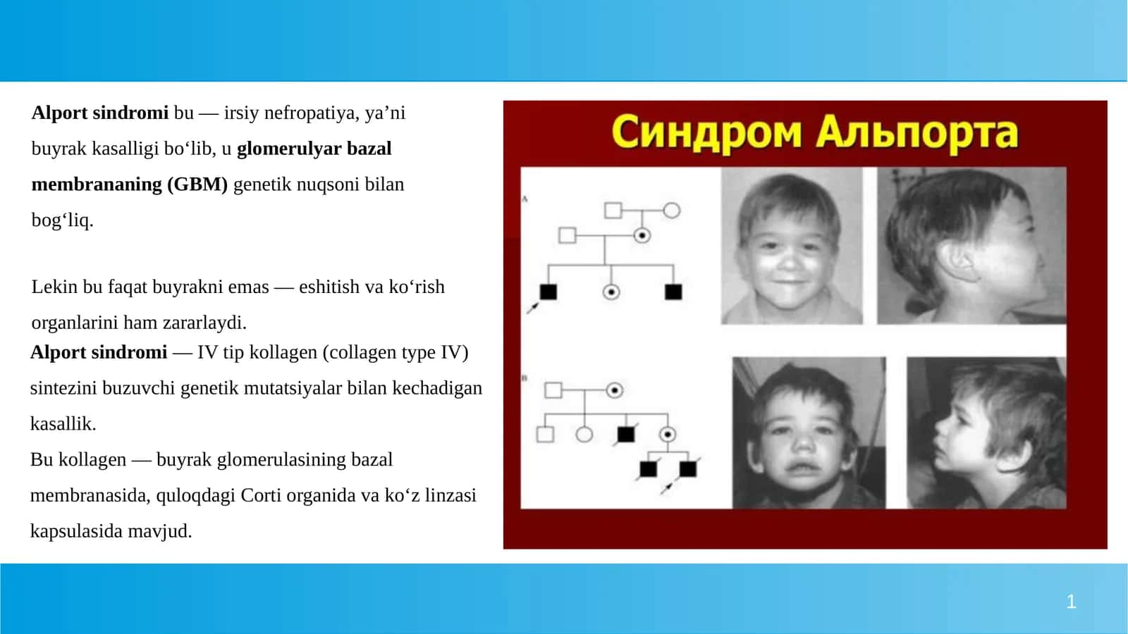 Alport sindromi