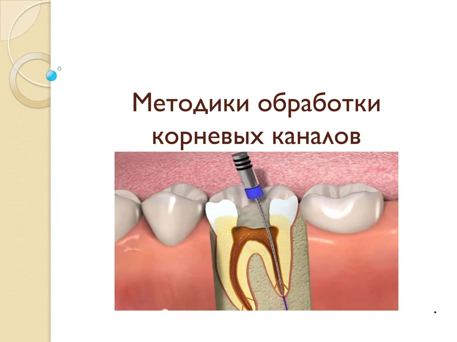 Методики обработки корневых каналов
