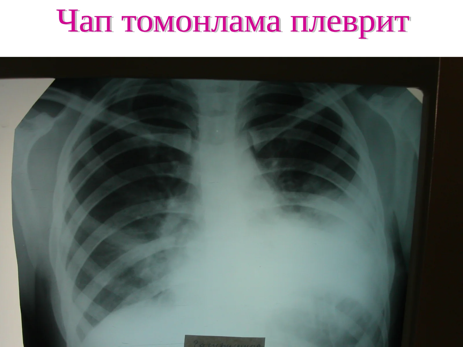 Чап томонлама плеврит