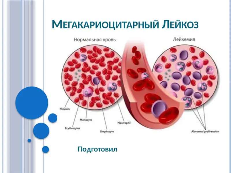 Острый мегакариоцитарный лейкоз