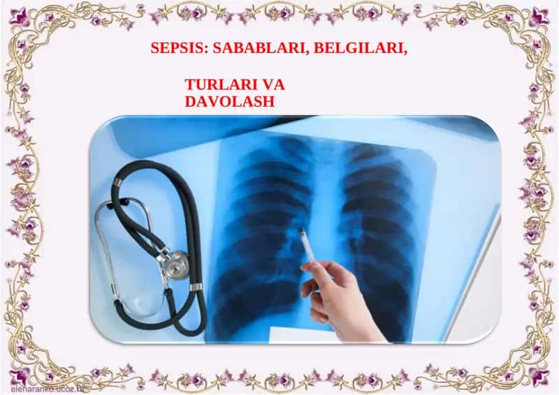 Sepsis: sabablari, belgilari, turlari va davolash