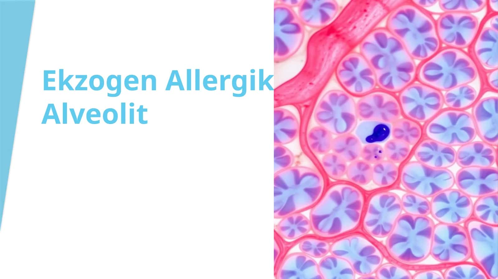 EkzogenAllergikAlveolit