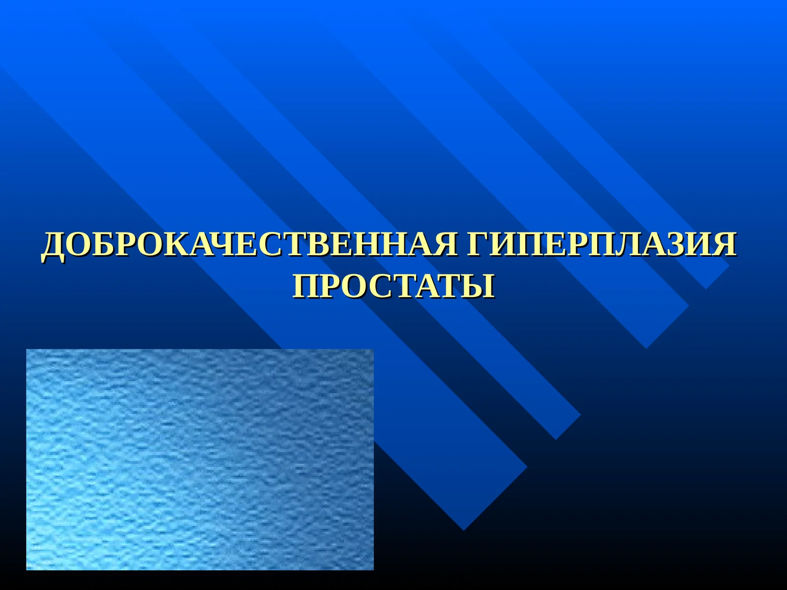 ДОБРОКАЧЕСТВЕННАЯ ГИПЕРПЛАЗИЯ ПРОСТАТЫ