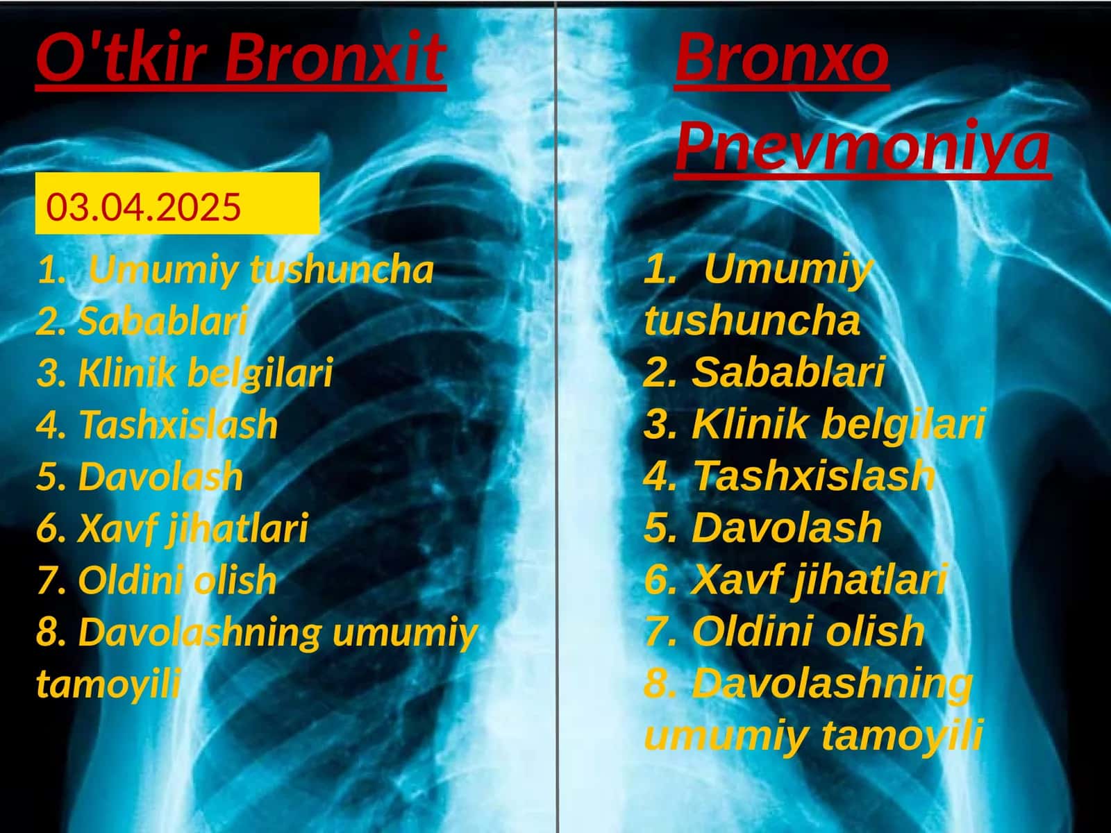 O'tkirBronxit