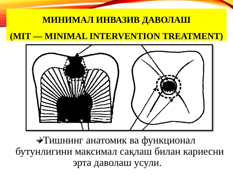 МИНИМАЛ ИНВАЗИВ ДАВОЛАШ (MIT — minimal intervention treatment)