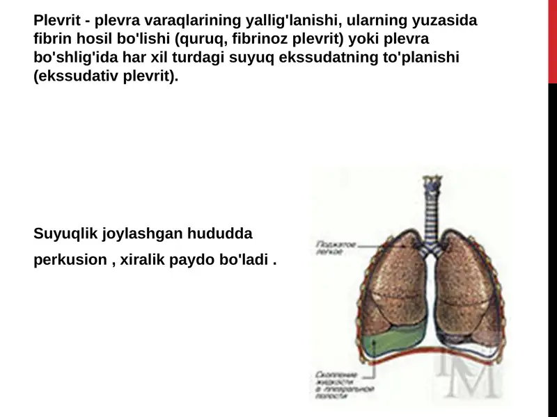 Plevritning tasnifi