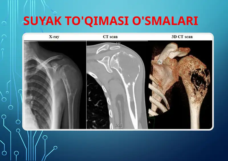 Suyak to'qimasi o'smalari