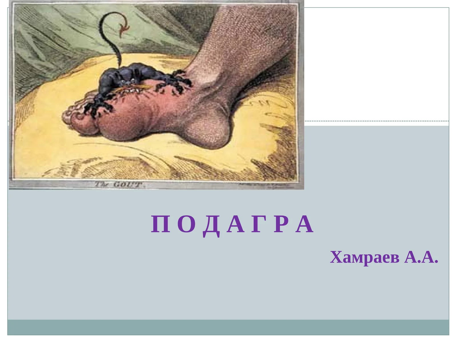 ПОДАГРА