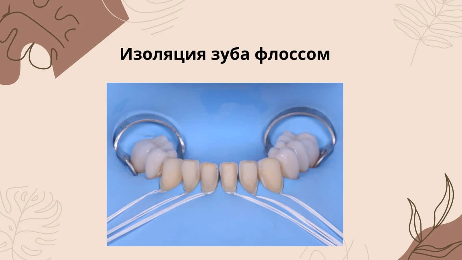 Изоляция зуба флоссом