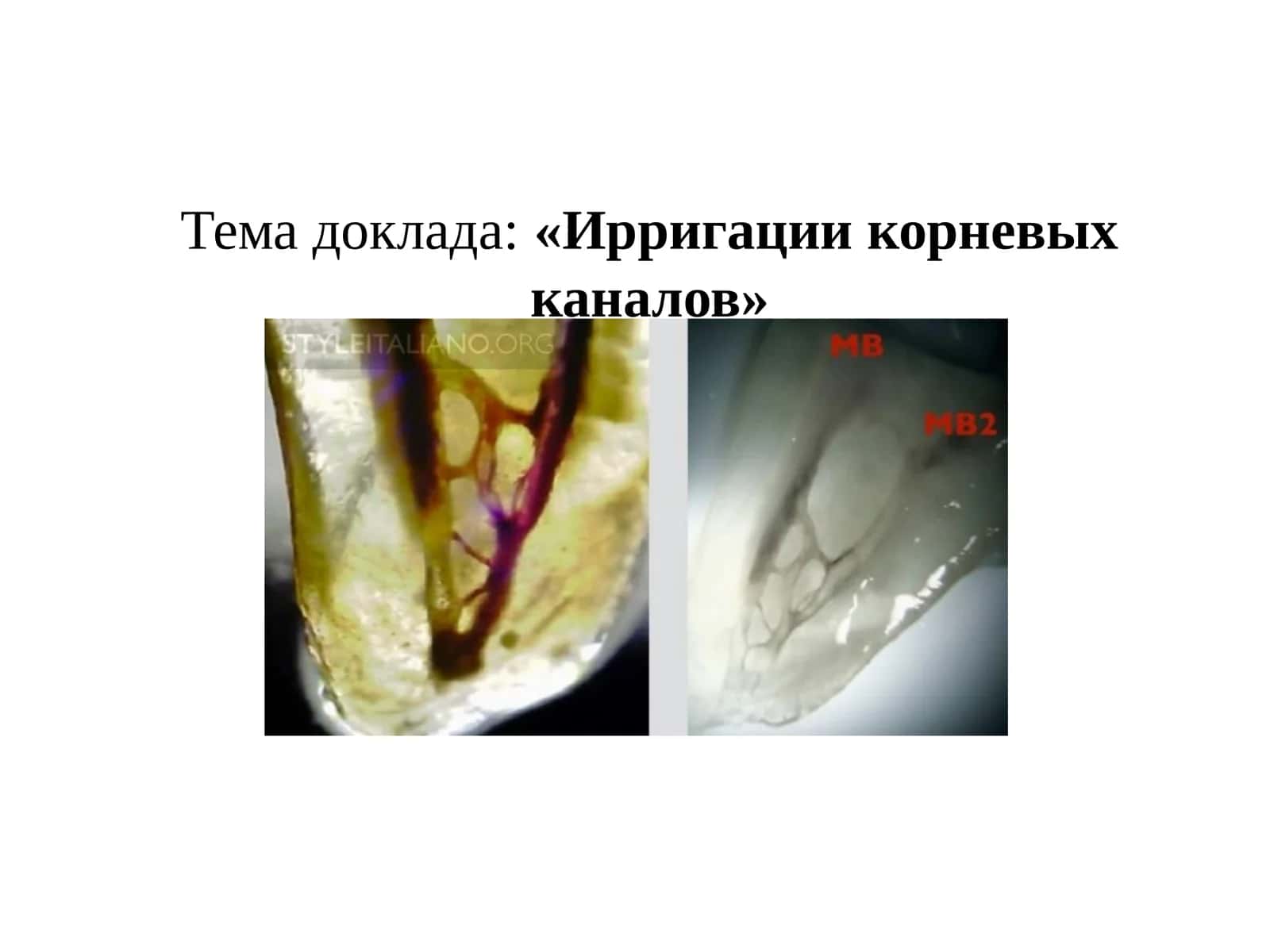 Ирригации корневых каналов