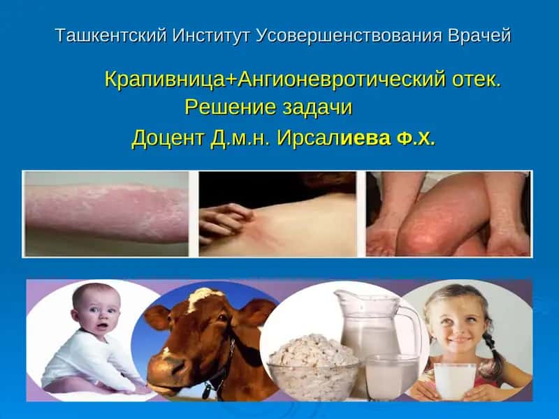 Крапивница