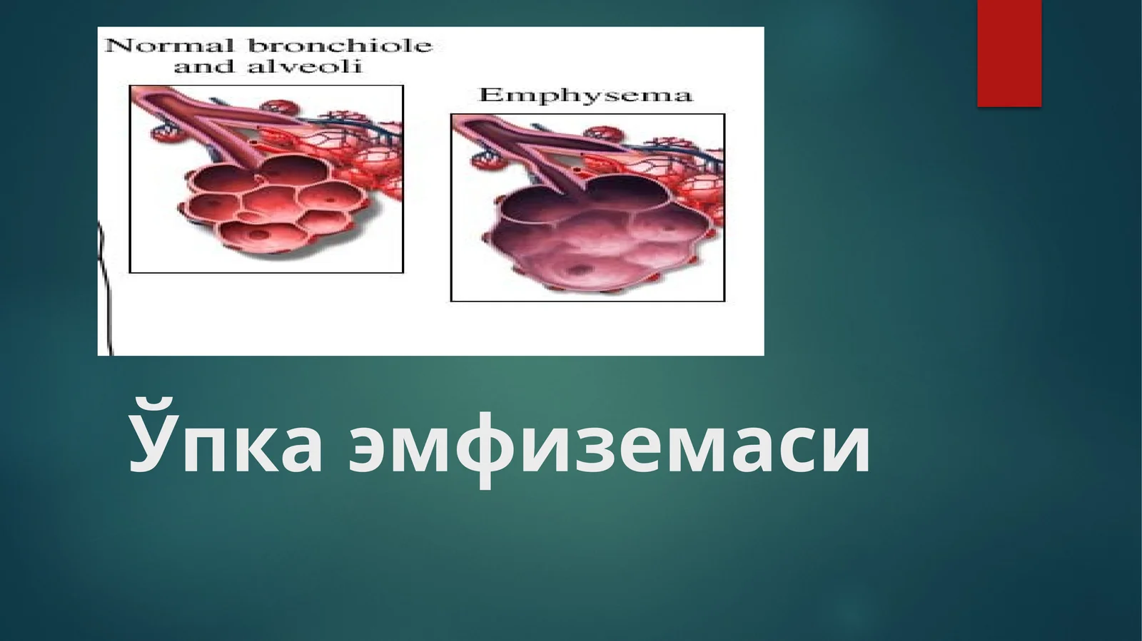 Ўпка эмфиземаси (o'ka emfuzemasi)