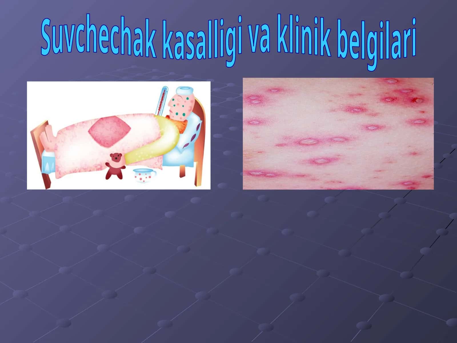 Suvchechak kasalligi va klinik belgilari