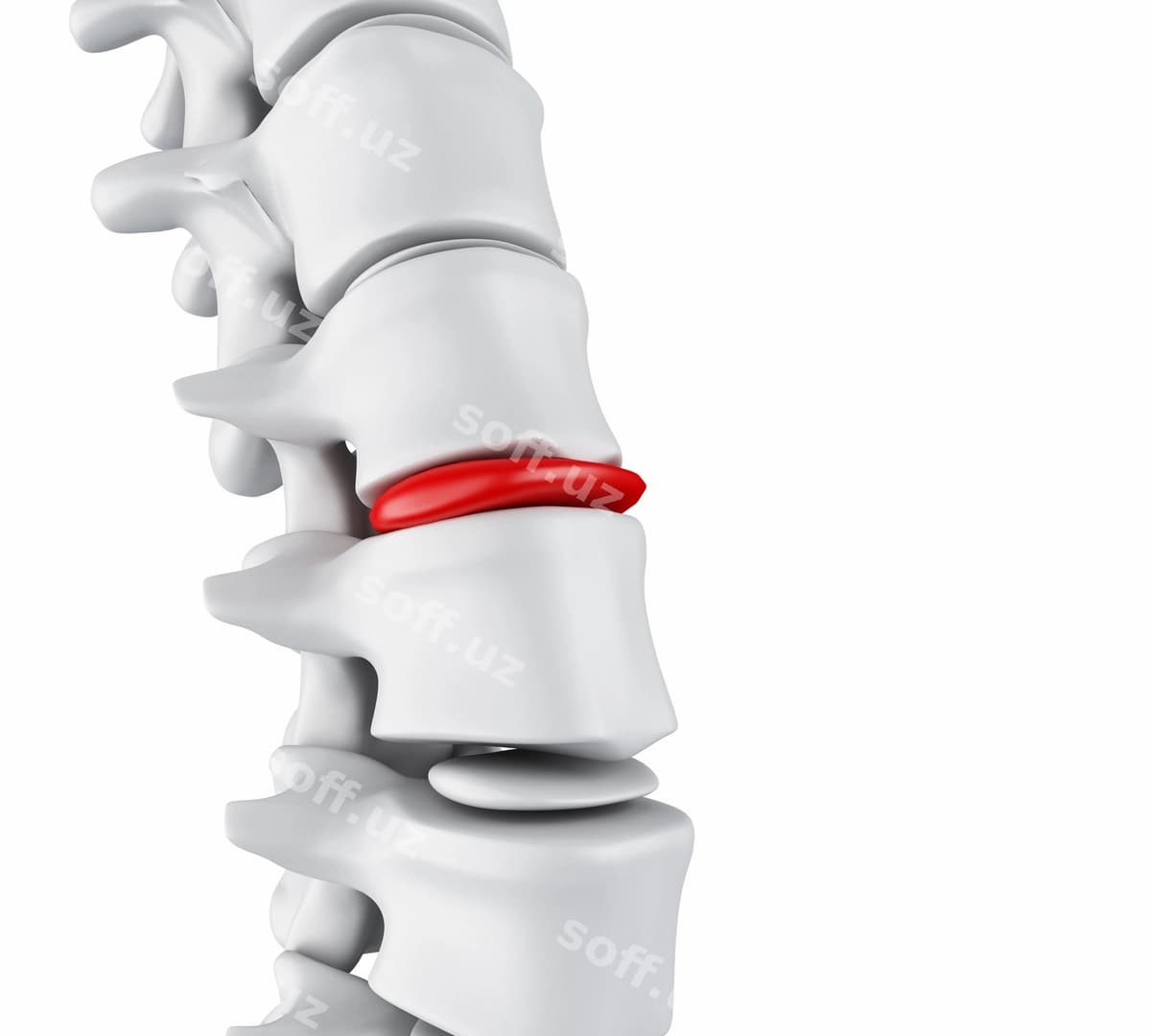 3D churrali disk tushunchasi | 3d herniated disk concept