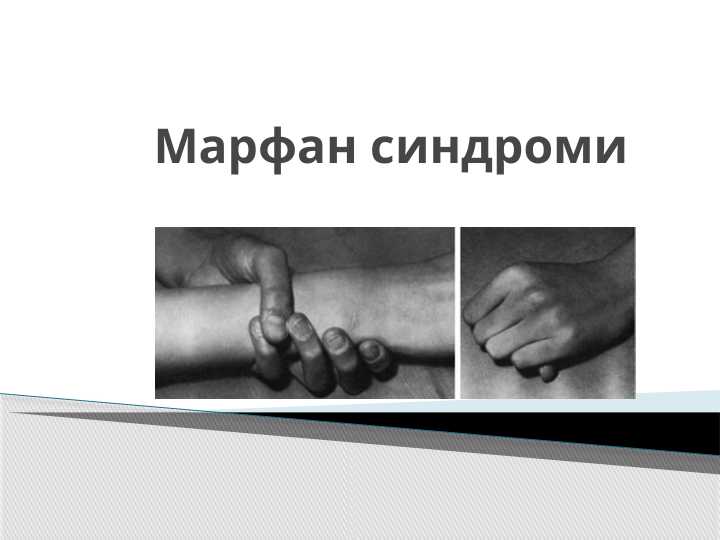 Marfan Sindromi . Марфан синдроми