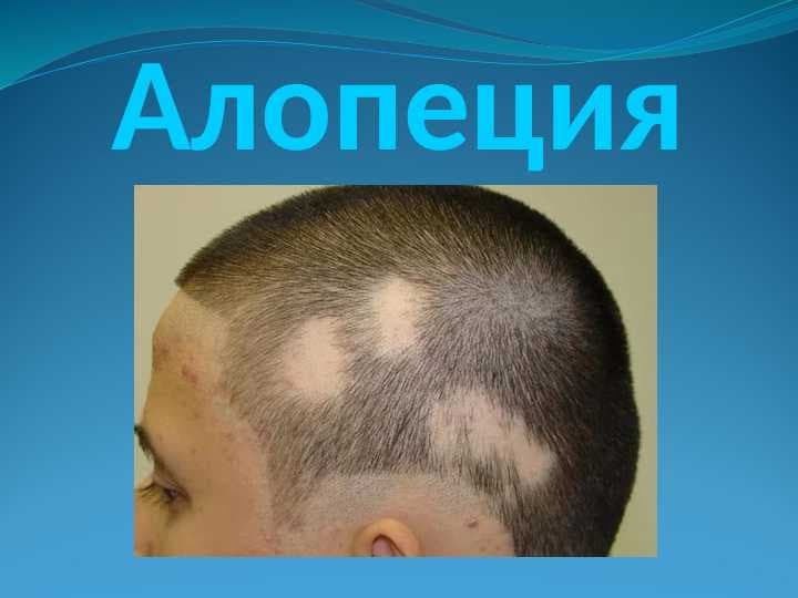 Алопеция