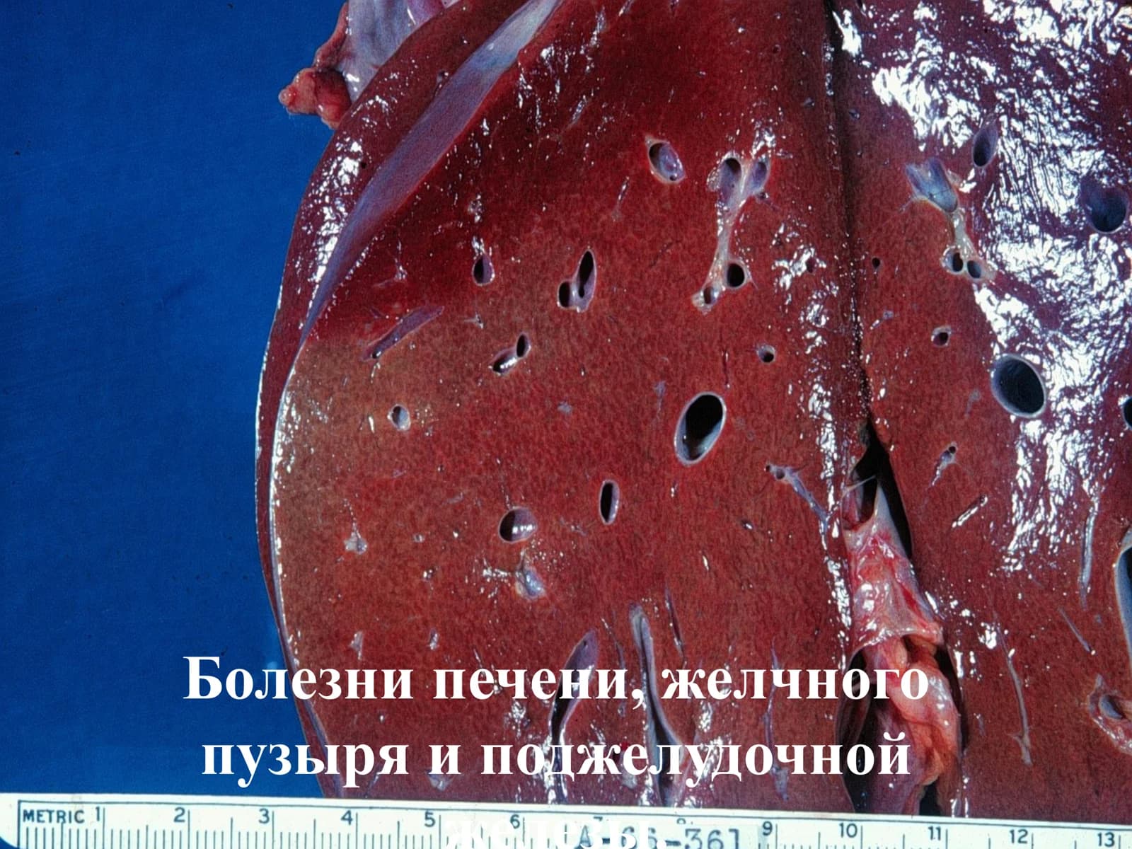 Болезни печени