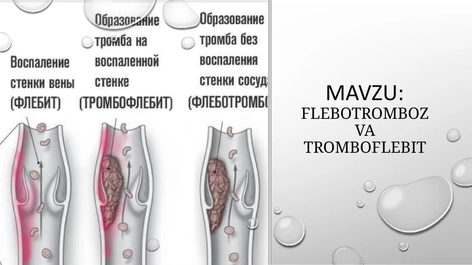 FLEBOTROMBOZ VA TROMBOFLEBIT