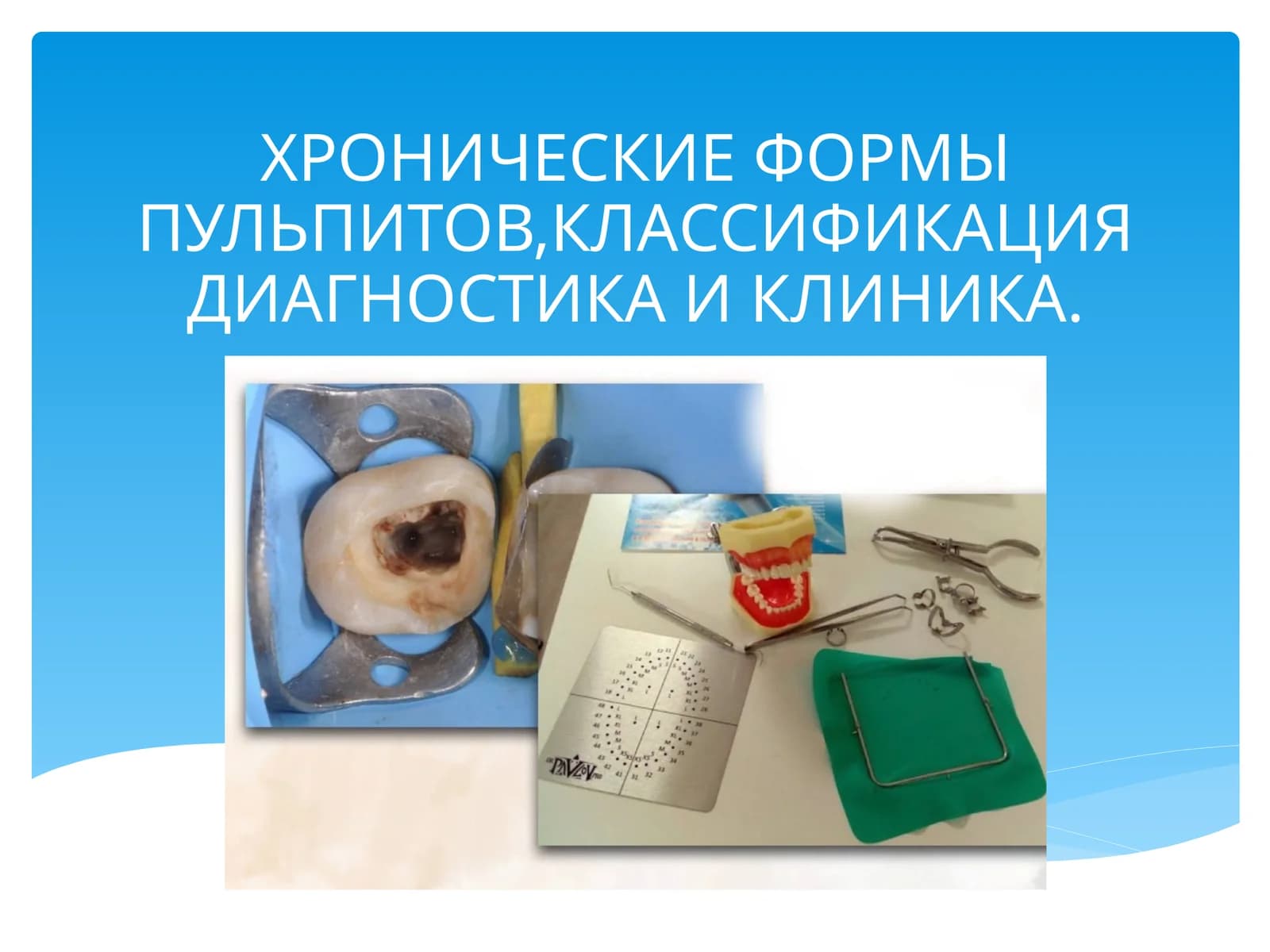 ХРОНИЧЕСКИЕ ФОРМЫ ПУЛЬПИТОВ,КЛАССИФИКАЦИЯ ДИАГНОСТИКА И КЛИНИКА