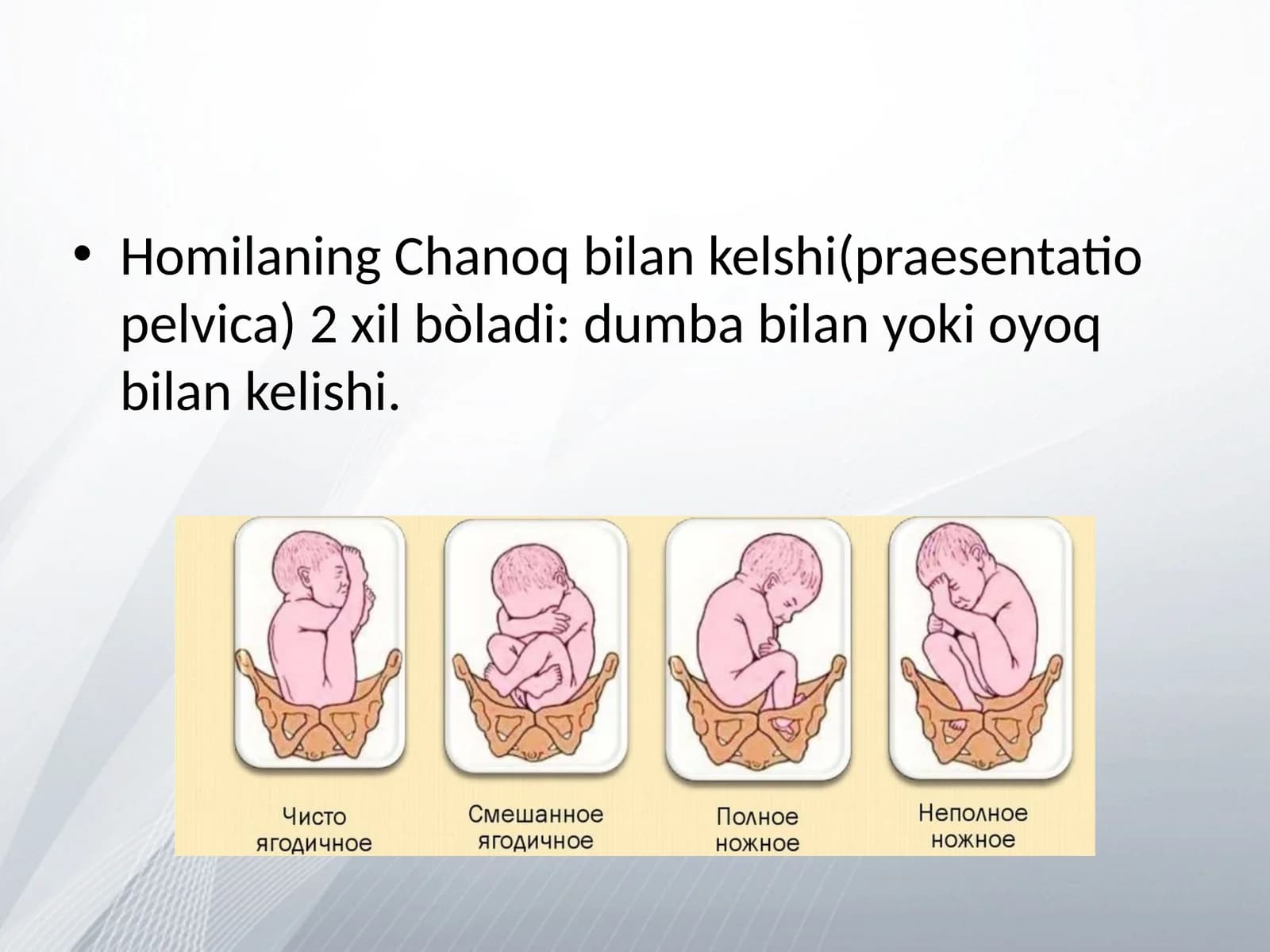 Homilaning Chanoq bilan kelshi(praesentatio pelvica)